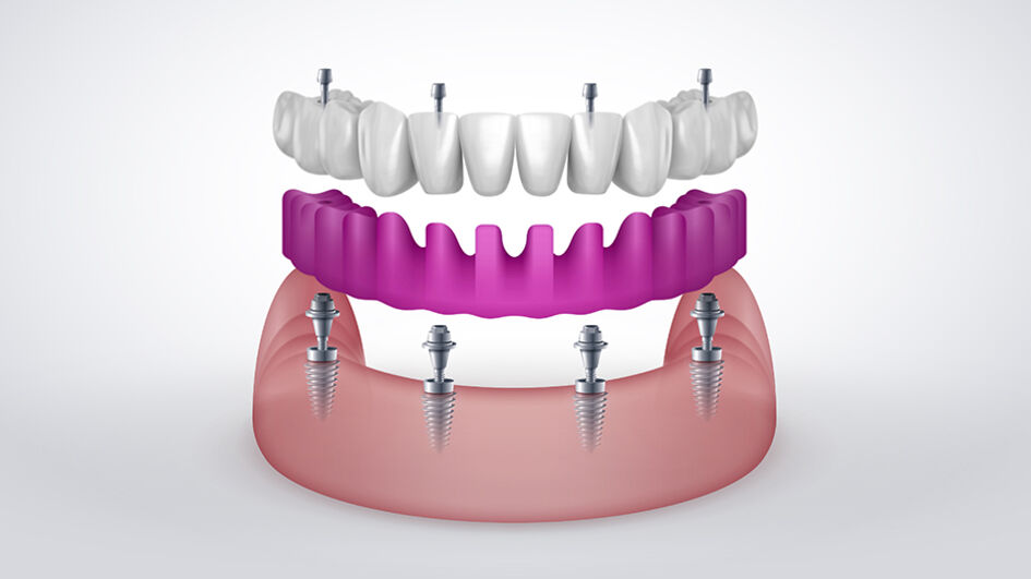 Graphic representation of the principle of SIEWERTBRIDGE®, a screw-retained denture specially developed for implants.