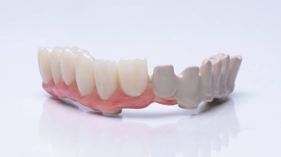 Case study of the intelligent SIEWERTBRIDGE® technology for dental restorations based on VESTAKEEP® PEEK. Right – The bridge construction made of natural-colored PEEK. Left – The final denture veneered with highly translucent full zirconia (©Evonik).